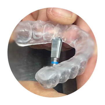 Gouttière dentaire
